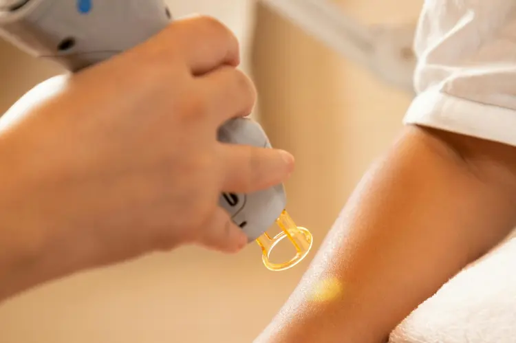 Investasi Sekali, Halus Selamanya! Kenapa Laser Hair Remover Wajib Kamu Punya?