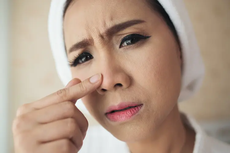 Kulit Mulus Bebas Komedo Hitam, Mungkinkah? Ini Jawabannya!