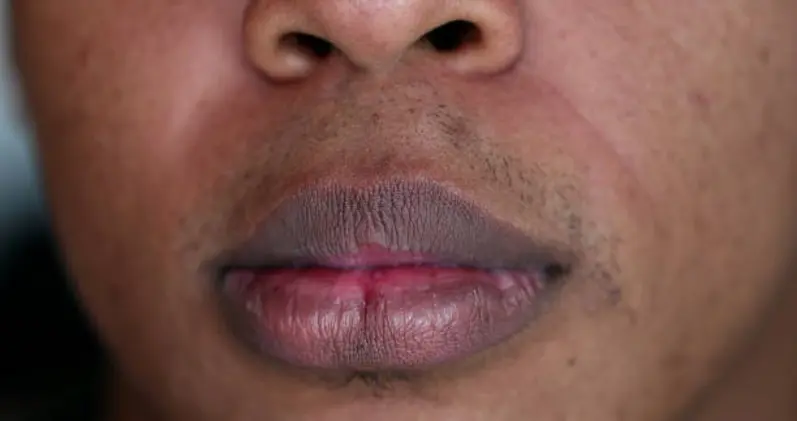 Apakah Lip Serum Bisa Mengatasi Bibir Gelap? Ini Penjelasannya