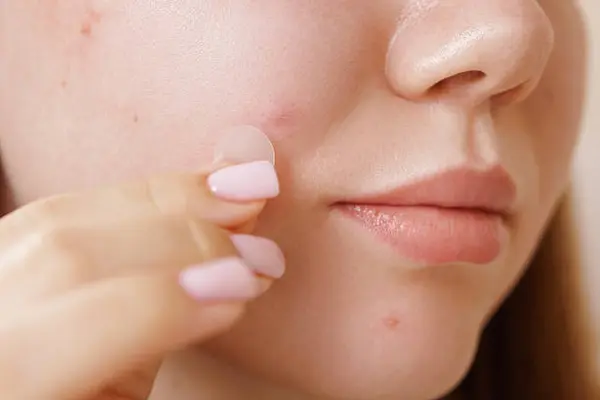 Kapan Waktu yang Tepat Menggunakan Pimple Patch?