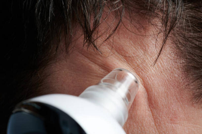 membersihkan kulit dahi dari komedo - alat penyedot komedo potret stok, foto, &amp; gambar bebas royalti