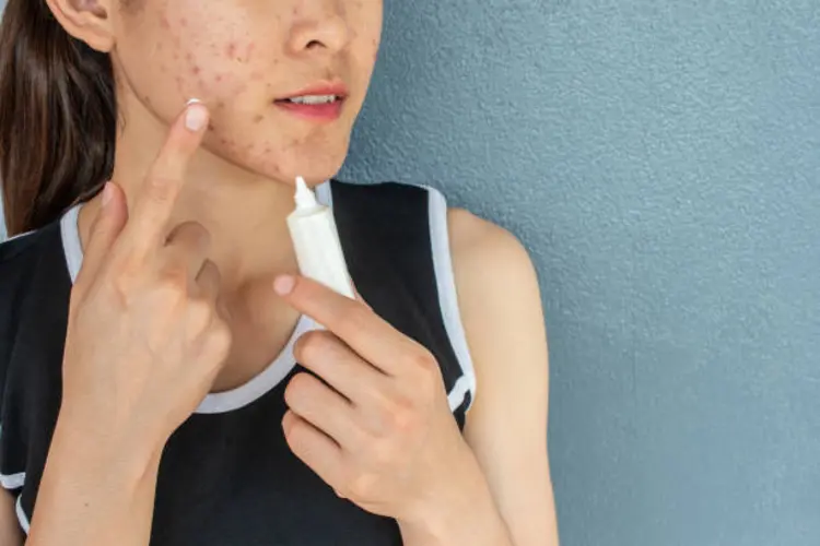 Kesalahan yang Sering Dilakukan dan Bikin Jerawat Makin Parah!